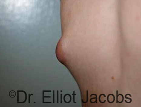 Male nipple, before Puffy Nipple treatment, l-side oblique view - patient 22