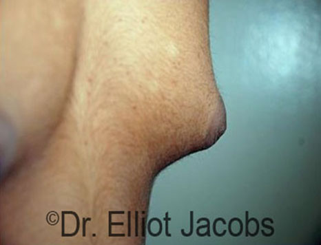 Male nipple, before Puffy Nipple treatment, r-side oblique view - patient 23