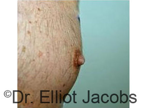 Male nipple, before Puffy Nipple treatment, oblique view - patient 38