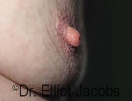 Male nipple, before Puffy Nipple treatment, oblique view - patient 39