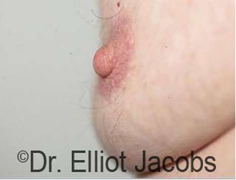 Male nipple, before Puffy Nipple treatment, side view - patient 39