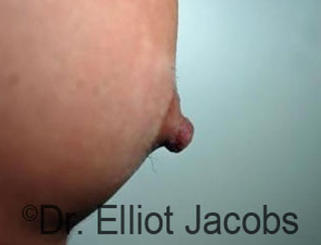 Male nipple, before Puffy Nipple treatment, oblique view - patient 40