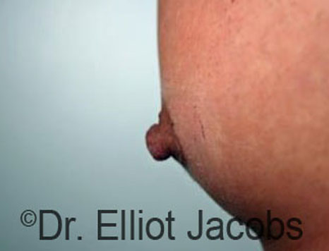 Male nipple, before Puffy Nipple treatment, side view - patient 40