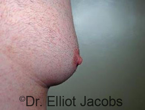 Male nipple, before Puffy Nipple treatment, oblique view - patient 41