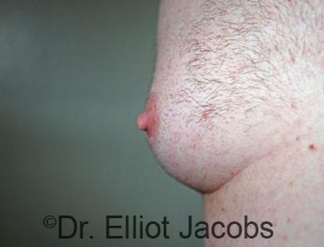 Male nipple, before Puffy Nipple treatment, side view - patient 41
