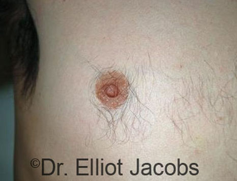Male nipple, before Puffy Nipple treatment, front view - patient 42