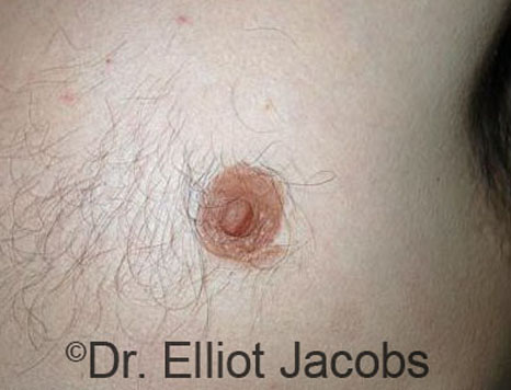 Male nipple, before Puffy Nipple treatment, front view - patient 42