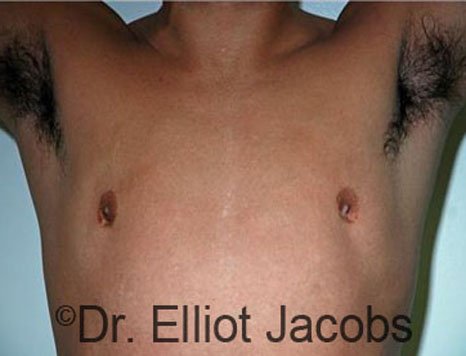 Men's breast, before Crater Deformity Repair treatment, front view - patient 1