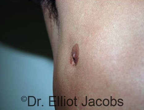 Men's breast, before Crater Deformity Repair treatment, front view, patient 1