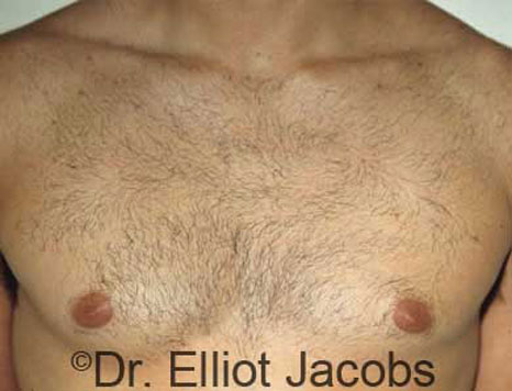 Male breast, before Gynecomastia treatment, front view, patient 21