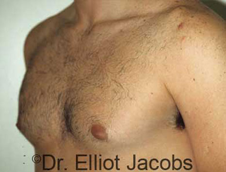 Male breast, before Gynecomastia treatment, l-side oblique view - patient 21