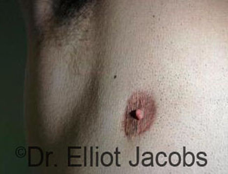 Men's breast, before Crater Deformity Repair treatment, front view - patient 2