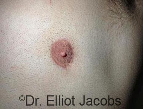 Men's breast, before Crater Deformity Repair treatment, front view, patient 2