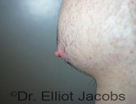 Male nipple, before Puffy Nipple treatment, oblique view - patient 43