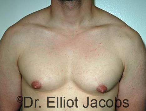 Men's breast, before Gynecomastia treatment in Bodybuilders, front view - patient 24