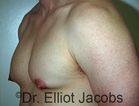 Men's breast, before Gynecomastia treatment in Bodybuilders, oblique view - patient 24