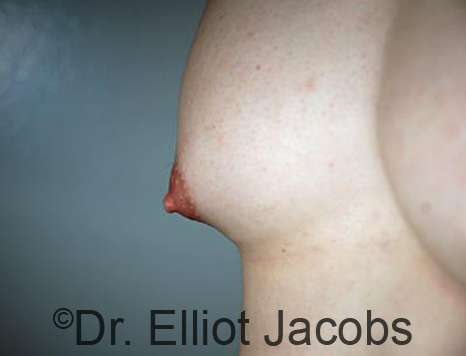Male nipple, before Puffy Nipple treatment, r-side oblique view - patient 25