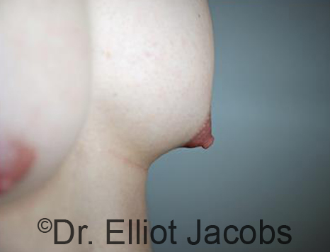 Male nipple, before Puffy Nipple treatment, l-side oblique view - patient 25