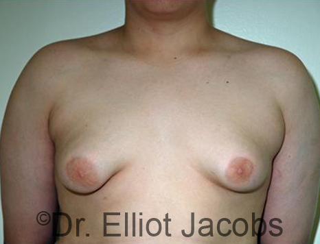 Men's breast, before Gynecomastia Adolescent treatment, front view - patient 28