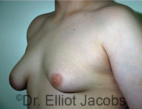 Men's breast, before Gynecomastia Adolescent treatment, oblique view - patient 28