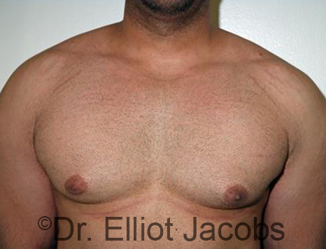 Men's breast, before Gynecomastia treatment in Bodybuilders, front view - patient 25