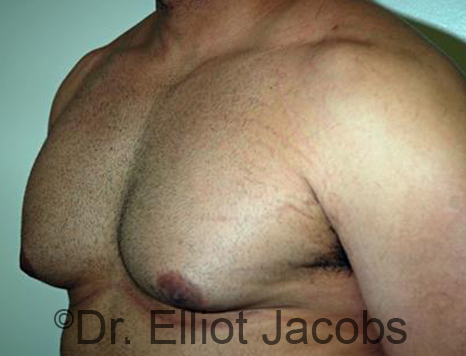 Men's breast, before Gynecomastia treatment in Bodybuilders, oblique view - patient 25