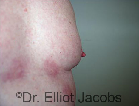 Male nipple, before Puffy Nipple treatment, oblique view - patient 44