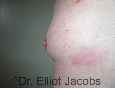 Male nipple, before Puffy Nipple treatment, side view - patient 44