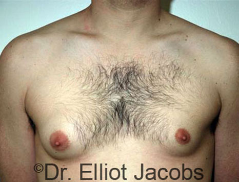 Male breast, before Gynecomastia treatment, front view, patient 22