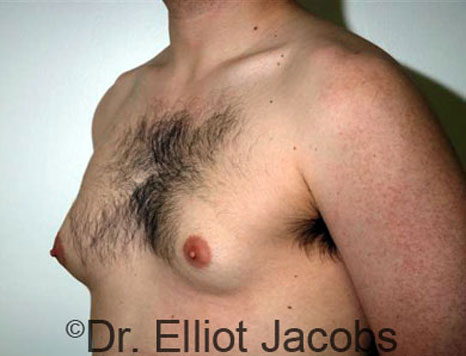 Male breast, before Gynecomastia treatment, l-side oblique view - patient 22