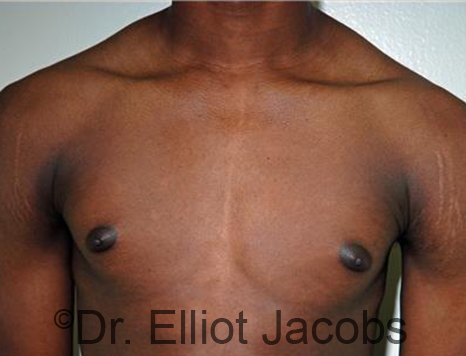 Men's breast, before Gynecomastia Adolescent treatment, front view - patient 29