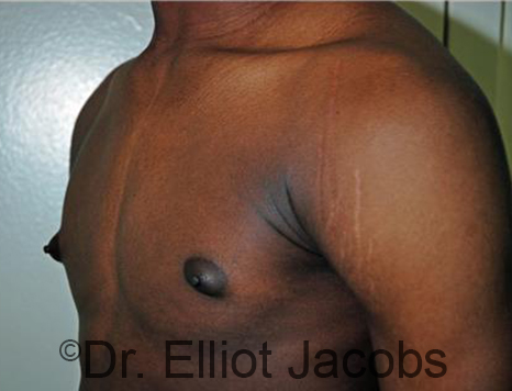 Men's breast, before Gynecomastia Adolescent treatment, oblique view - patient 29