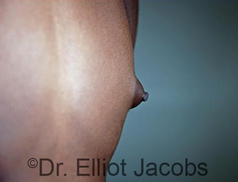 Male nipple, before Puffy Nipple treatment, r-side oblique view - patient 26