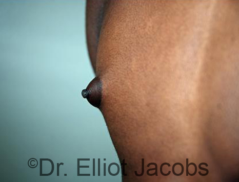 Male nipple, before Puffy Nipple treatment, l-side oblique view - patient 26
