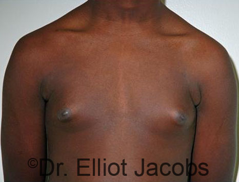 Men's breast, before Gynecomastia Adolescent treatment, front view - patient 30