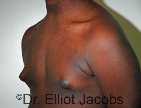 Men's breast, before Gynecomastia Adolescent treatment, oblique view - patient 30