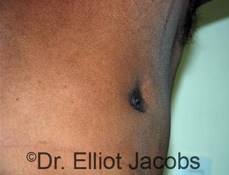 Men's breast, before Crater Deformity Repair treatment, front view - patient 3