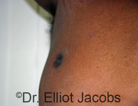 Men's breast, before Crater Deformity Repair treatment, front view, patient 3