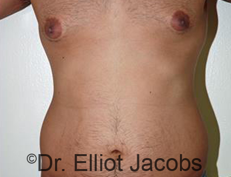 Male body, before Torsoplasty treatment, front view, patient 23