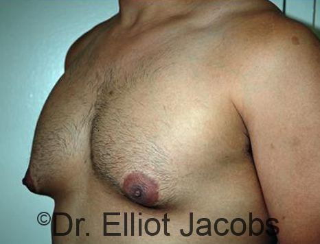 Male body, before Torsoplasty treatment, l-side oblique view, patient 23
