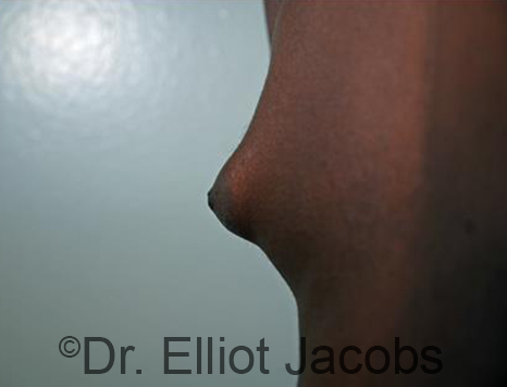 Male nipple, before Puffy Nipple treatment, l-side oblique view - patient 27