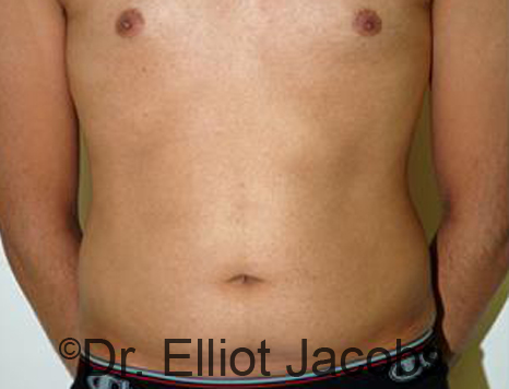 Male body, before Torsoplasty treatment, front view, patient 24