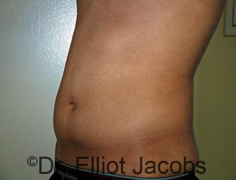 Male body, before Torsoplasty treatment, l-side oblique view, patient 24