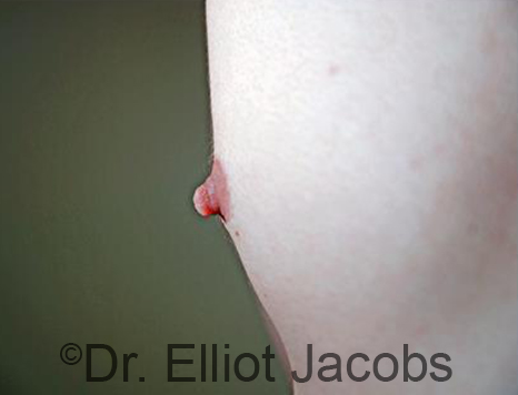 Male nipple, before Puffy Nipple treatment, oblique view - patient 45