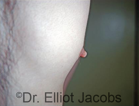 Male nipple, before Puffy Nipple treatment, side view - patient 45