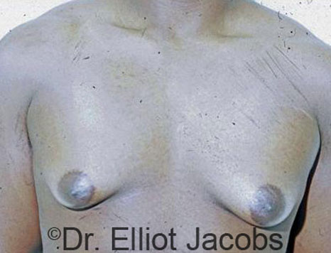 Male breast, before Gynecomastia treatment, front view, patient 23