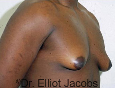 Male breast, before Gynecomastia treatment, r-side oblique view - patient 23