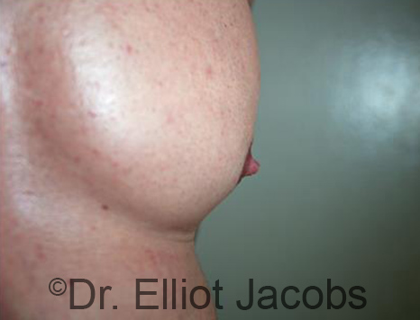 Male nipple, before Puffy Nipple treatment, oblique view - patient 46