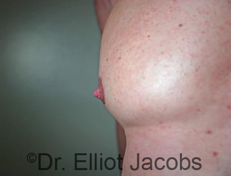 Male nipple, before Puffy Nipple treatment, side view - patient 46