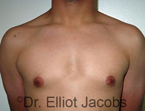 Men's breast, before Gynecomastia Adolescent treatment, front view - patient 31